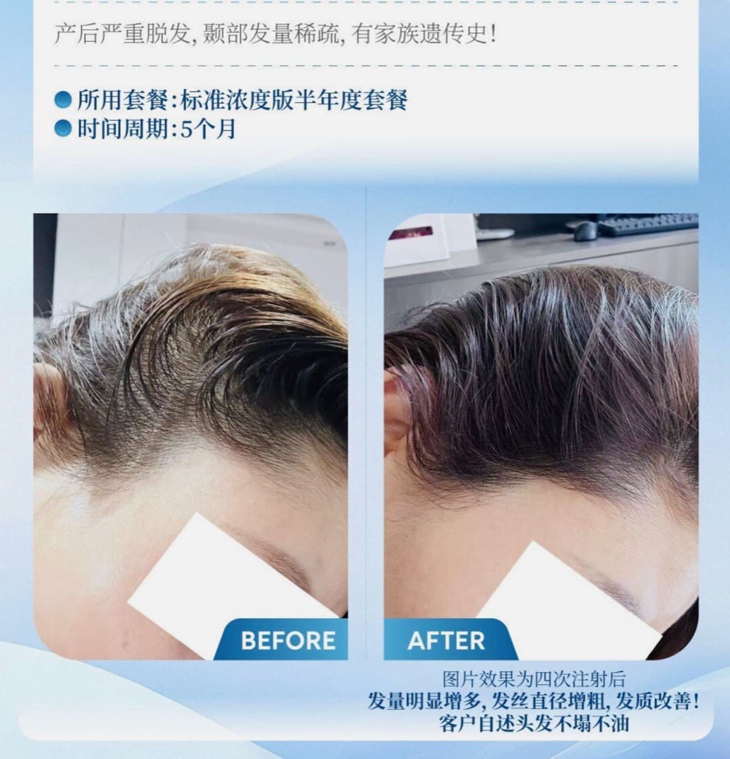 发际线与额角改善前后对比
