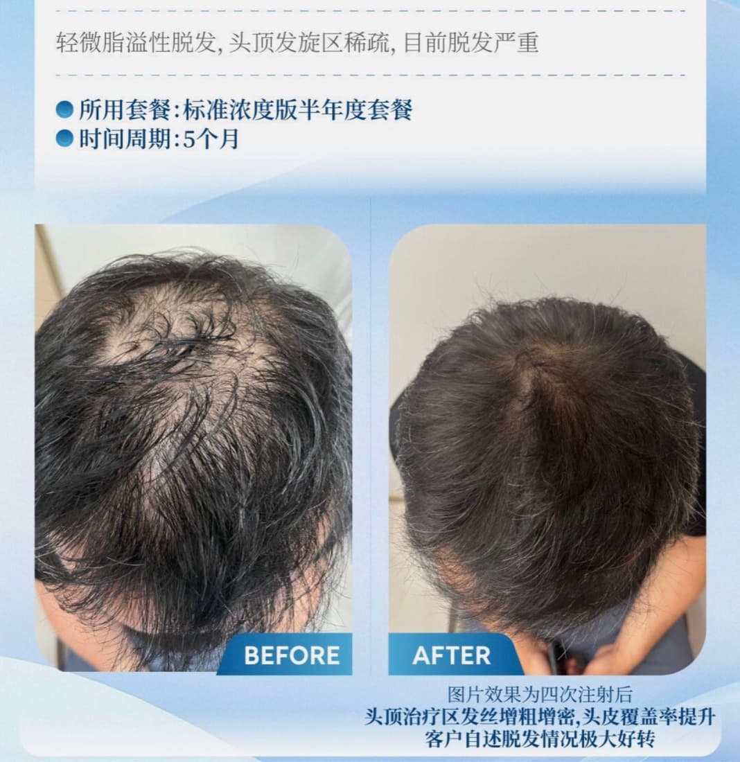 头顶稀疏改善前后对比